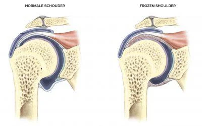 Herken een frozen shoulder!