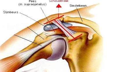 Impingement Syndroom meest gestelde diagnose bij schouderklachten